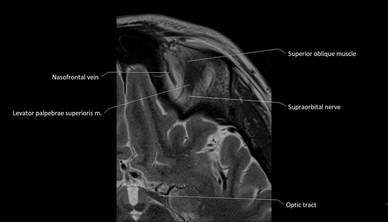 MRI Orbit axial cross sectional anatomy image 13.webp